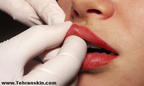 تزریق فیلر در کرج