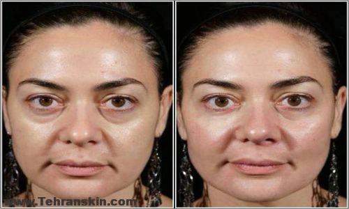 تزریق فیلر زیر چشم در مشهد