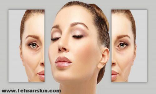 تخفیف بوتاکس در کرج