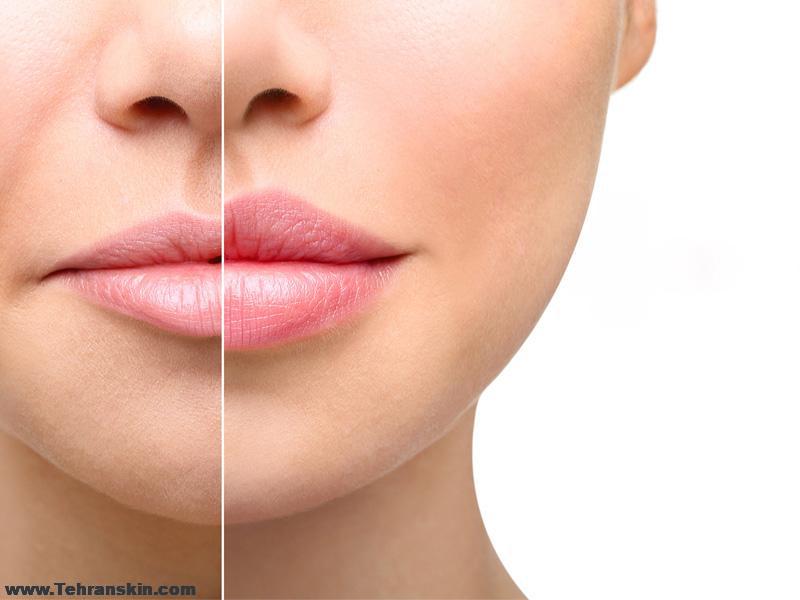 تزریق فیلر در جیرفت