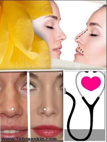 بهترین جراح بینی طبیعی در ایران و تهران