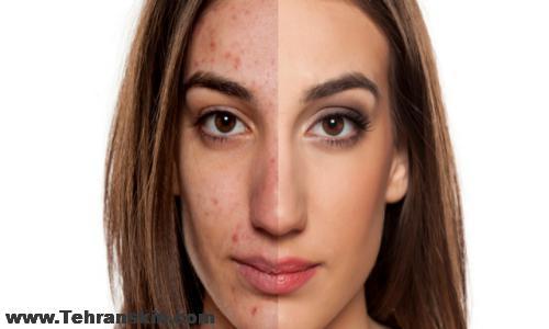 میکرونیدلینگ در کرج