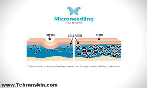میکرونیدلینگ در کرج