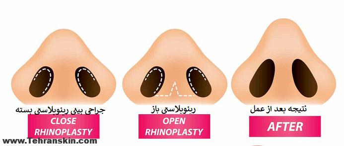 متخصص جراحی بینی در مشهد رینوپلاستی بسته