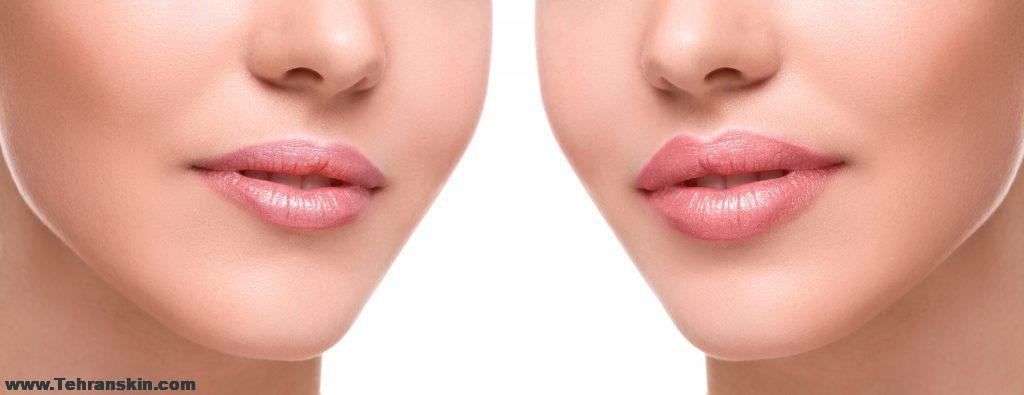 تزریق ژل لب