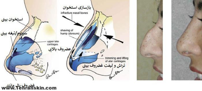 انواع عمل بینی