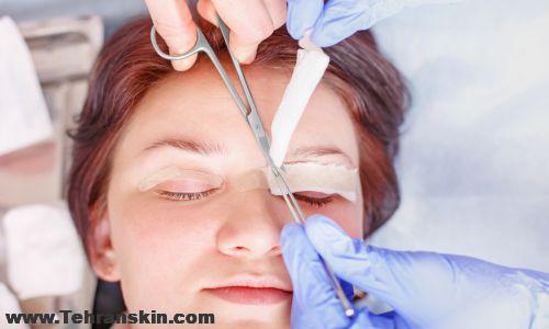 بلفاروپلاستی پلک بالا