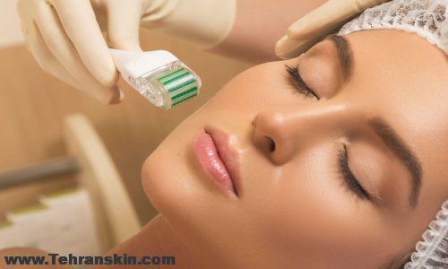 میکرونیدلینگ در همدان