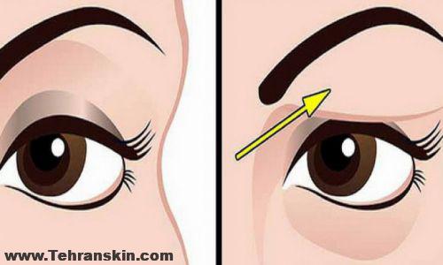 درمان افتادگی پلک با لیزر