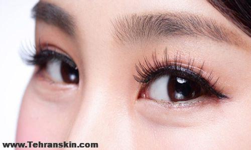 درمان ورم چشم بعد ازعمل