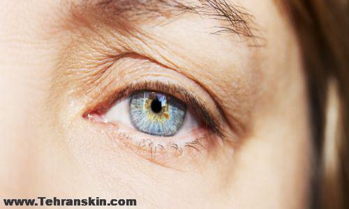 هزینه لیزر افتادگی پلک