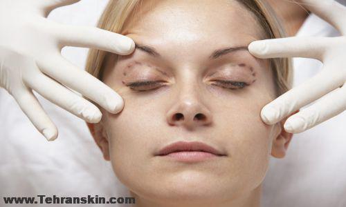 درمان افتادگی پلک در طب سنتی