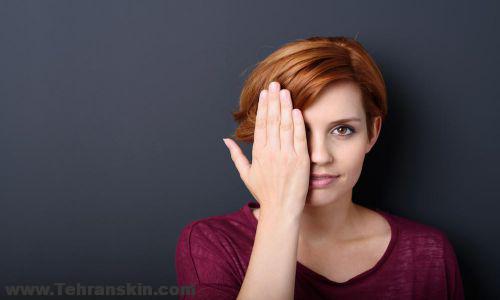 درمان افتادگی پلک با زالو درمانی