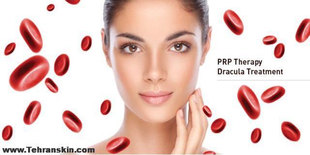 پی آر پی صورت