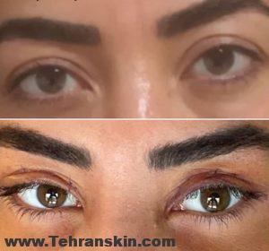 بهترین فوق تخصص جراحی پلک در تهران | هزینه جراحی بلفاروپلاستی 79374460 1607725166033838 8673482822971338962 n 1 300x280 - بهترین فوق تخصص جراحی پلک در تهران | هزینه جراحی بلفاروپلاستی