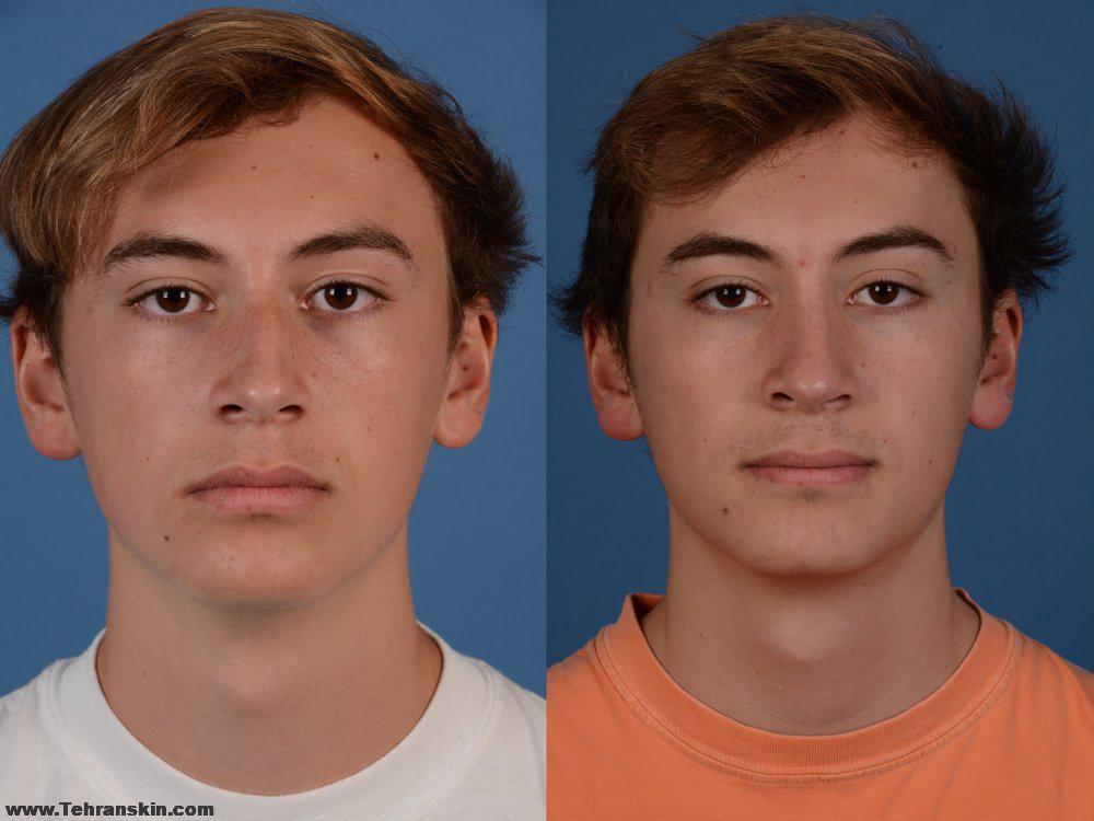 عمل انحراف بینی