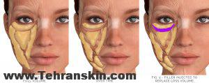 فیلر زیر چشم چیست و بهترین مارک فیلر زیر چشم چیست؟ UndereyeFiller Chart 300x119 - فیلر زیر چشم چیست و بهترین مارک فیلر زیر چشم چیست؟
