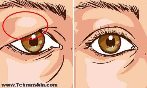 درمان افتادگی پلک بدون جراحی
