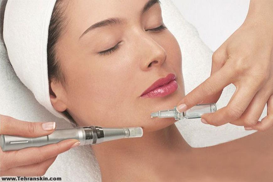 میکرونیدلینگ در بجنورد