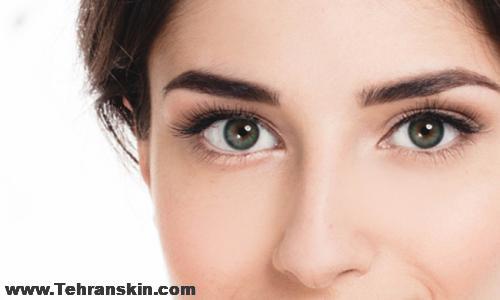 بلفاروپلاستی شریعتی