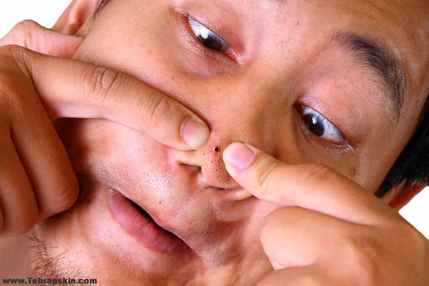 چگونه دانه های سیاه روی بینی را از بین ببریم