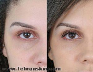فیلر زیر چشم چیست و بهترین مارک فیلر زیر چشم چیست؟ under eye filler 1024x792 1 300x232 - فیلر زیر چشم چیست و بهترین مارک فیلر زیر چشم چیست؟