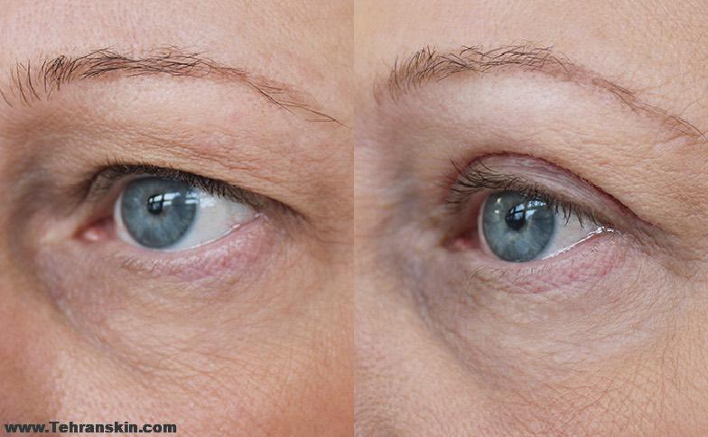 فیلم جراحی پلک بالا
