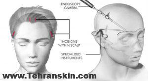 آندوسکوپی لیفت ابرو و درمان افتادگی پلک ها