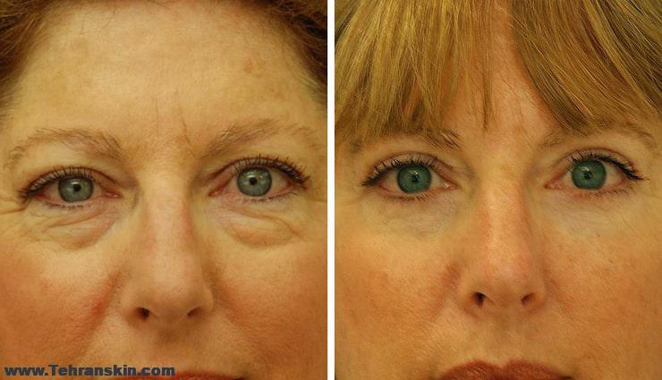 بلفاروپلاستی در شمال تهران