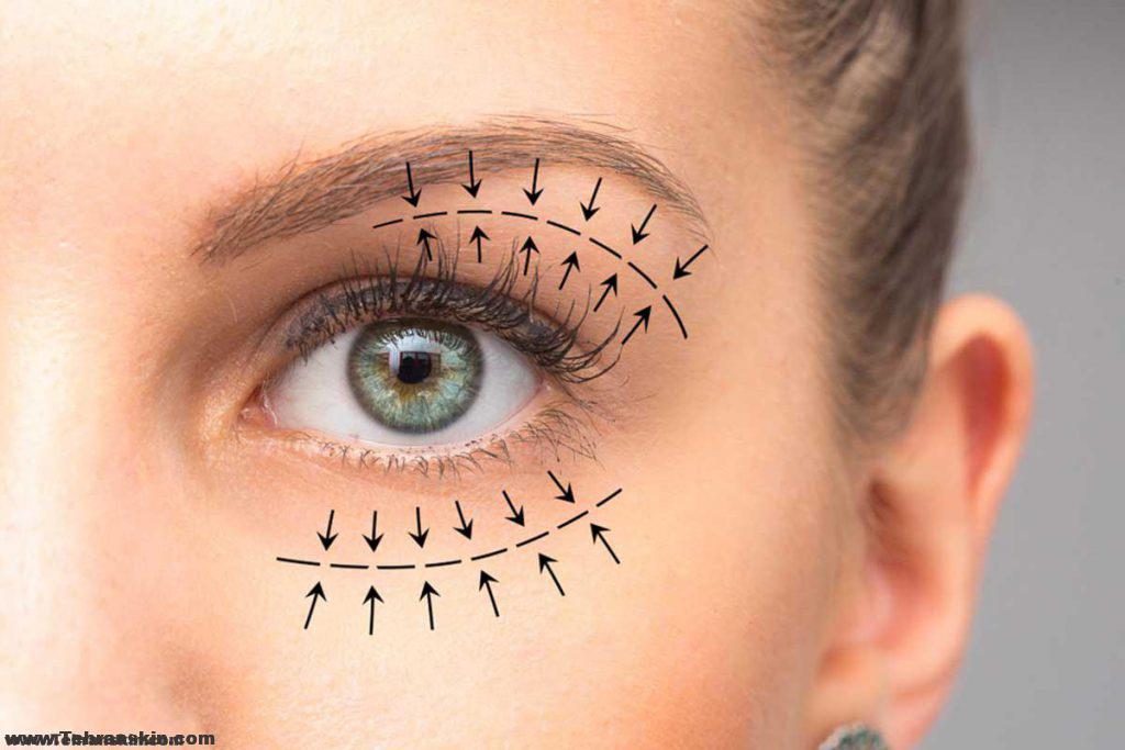 بلفاروپلاستی در مرکز برکه