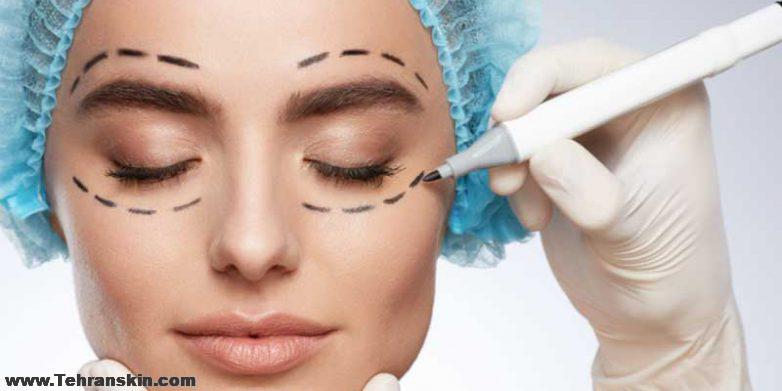 بلفاروپلاستی در مرکز برکه