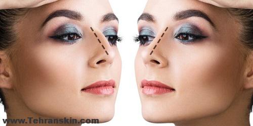 تخفیف جراحی زیبایی بینی رینوپلاستی