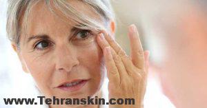 درمان افتادگی پلک بالای چشم با بلفاروپلاستی