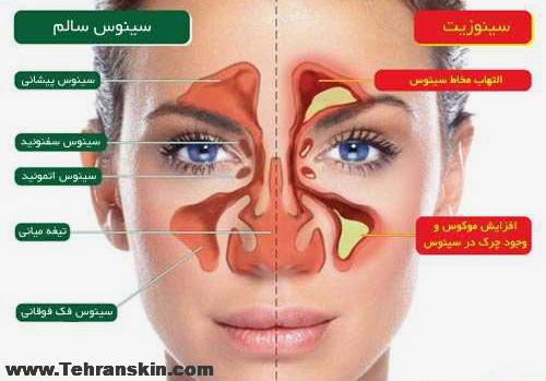 تفاوت سینوس سالم و سینوزیت