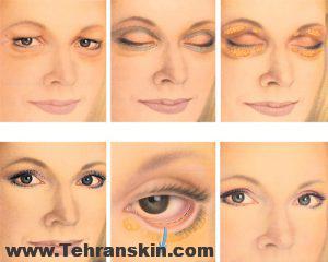 جراحی پلک و جوانسازی چشم ها