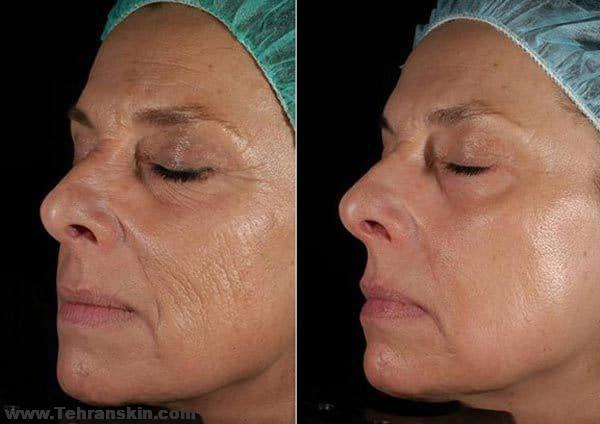 جوانسازی پوست به کمک لیزر