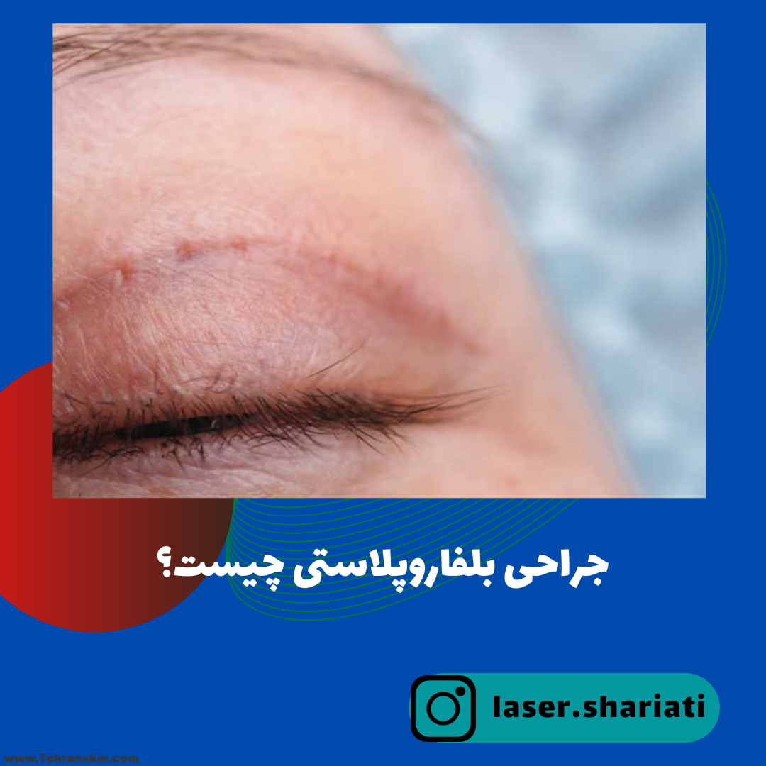 بهترین فوق تخصص جراحی پلک در تهران کیست؟