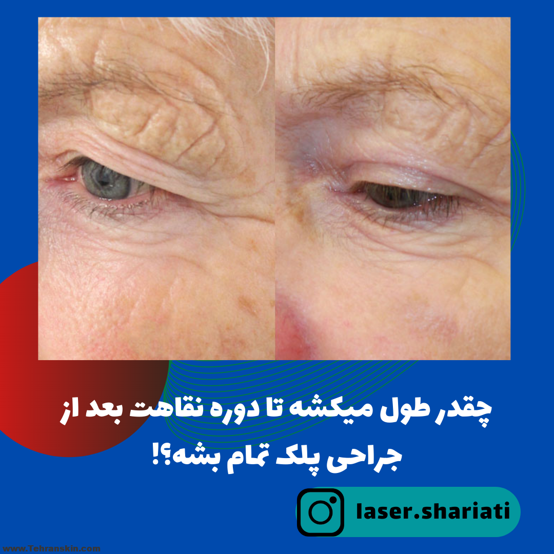 دوره نقاهت جراحی پلک