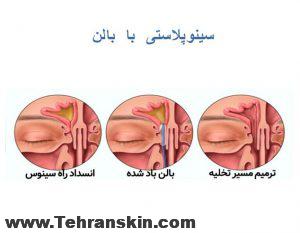 جراحی سینوپلاستی با بالون