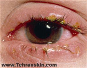 عفونت و التهاب پلک ها پس از جراحی