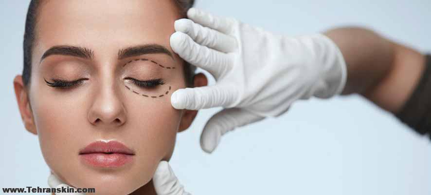 لیفت بافت اطراف چشم با نخ