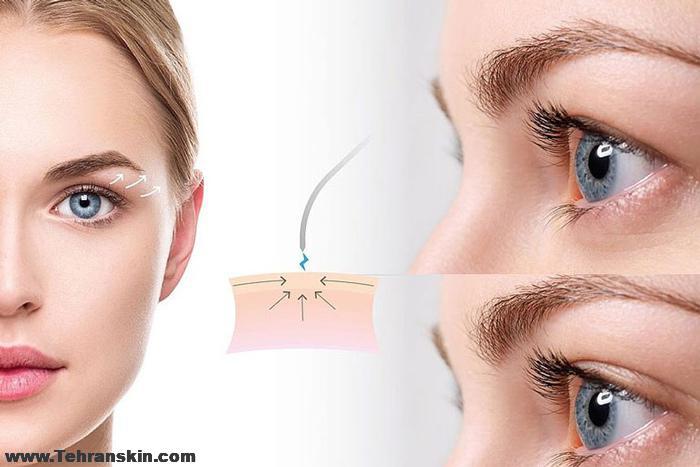 مهم ترین عوارض بلفاروپلاستی