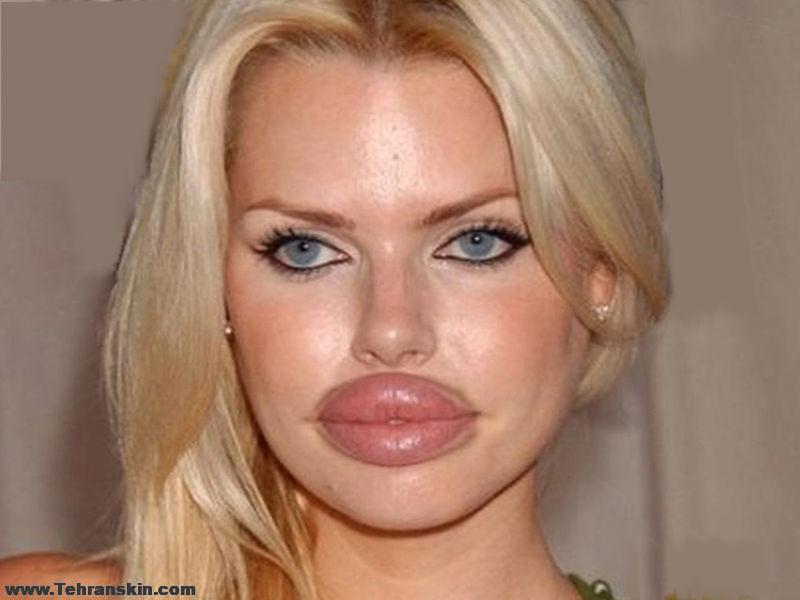 عوارض تزریق بیش از اندازه ژل لب