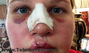 کبودی اطراف بینی و آبریزش بینی پس از جراحی