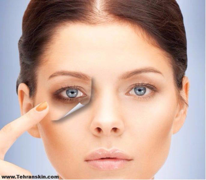 راه حل از بین بردن سیاهی دور چشم