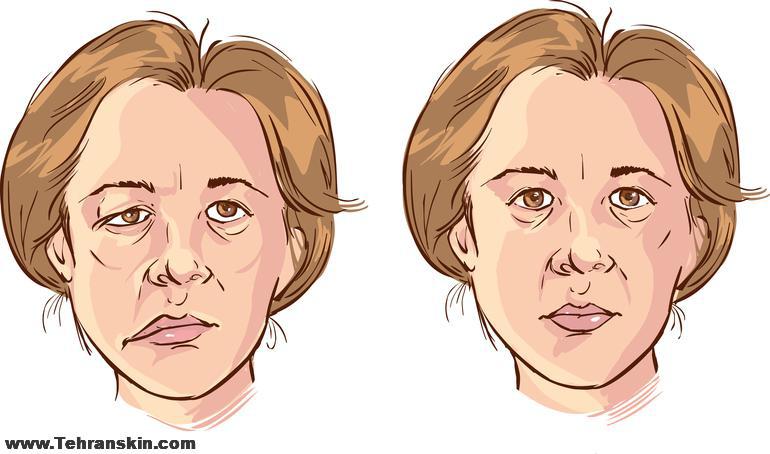 بوتاکس برای فلج بلز