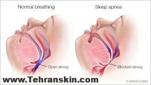 بیماری اپنه تنفسی چیست