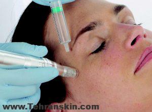 درمان قطعی لک صورت با مزوتراپی لک صورت 161229mesoesteticfaces218480 Copycloseup 300x221 - درمان قطعی لک صورت با مزوتراپی لک صورت