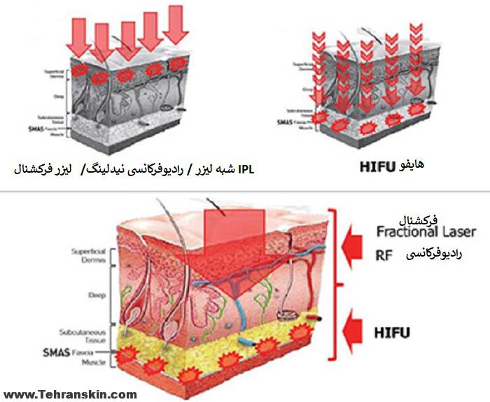 هایفو بهتره یا لیزر فرکشنال؟