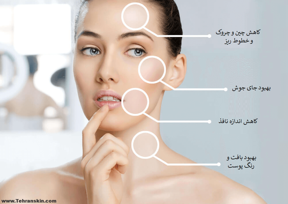 درمان قطعی لک صورت با مزوتراپی لک صورت Mesotherapy 1 - درمان قطعی لک صورت با مزوتراپی لک صورت